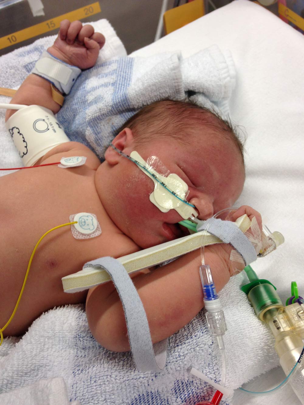 George had to undergo open heart surgery within his first few days of life